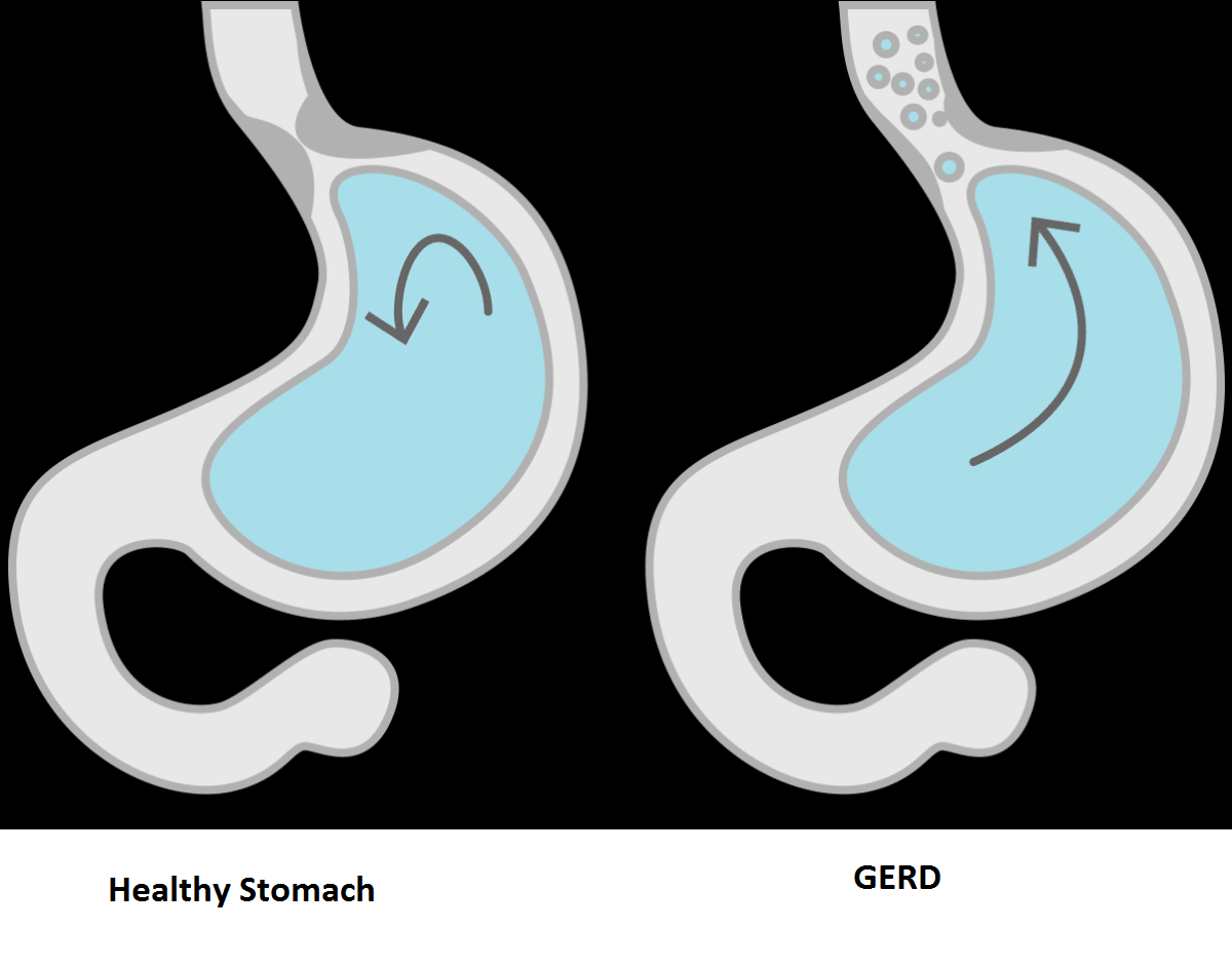 Don’t let your Reflux/ GERD to progress into Advanced Stage